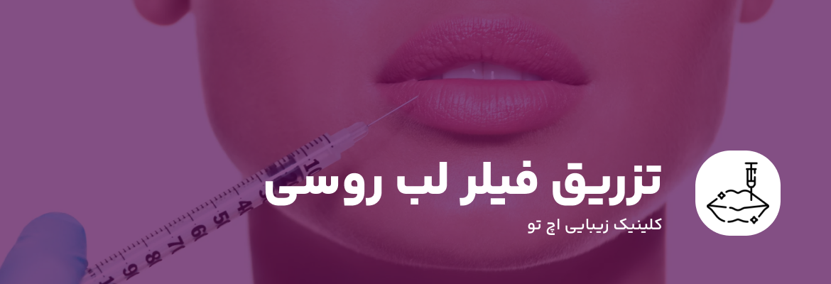 تزریق ژل لب روسی خط دار