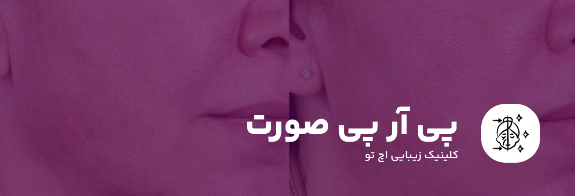 پی آر پی صورت چیست؟