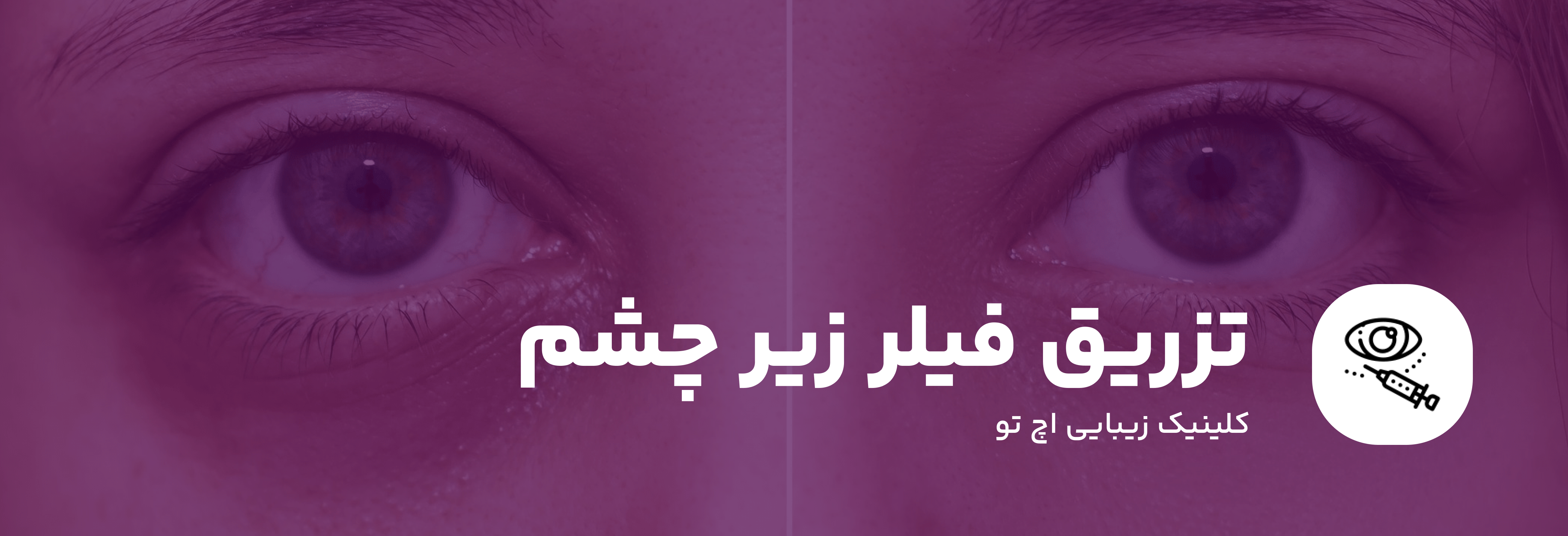 تزریق فیلر زیر چشم در شمال تهران
