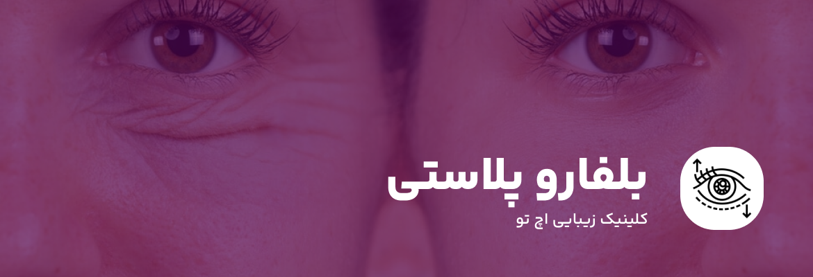 جراحی بلفاروپلاستی در شمال تهران