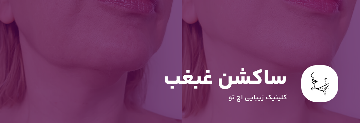 کلینیک ساکشن غبغب در شمال تهران