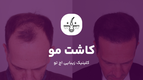 کاشت مو در شمال تهران