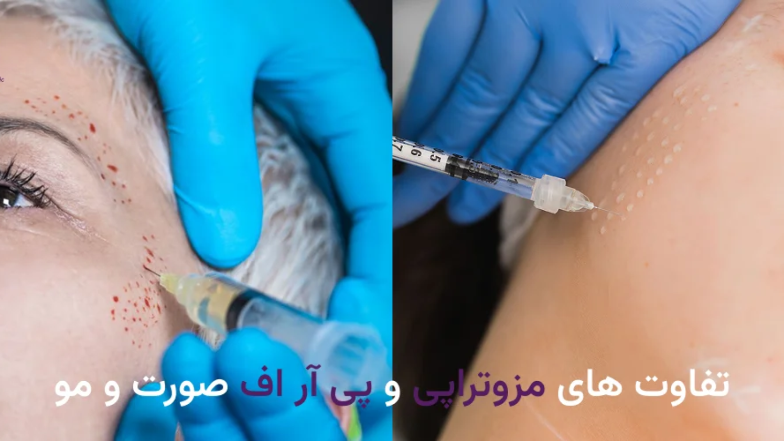 تفاوت مزوتراپی و پی آر اف صورت و مو