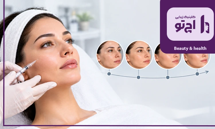 نتیجه تزریق PLLA در بازه های زمانی مختلف