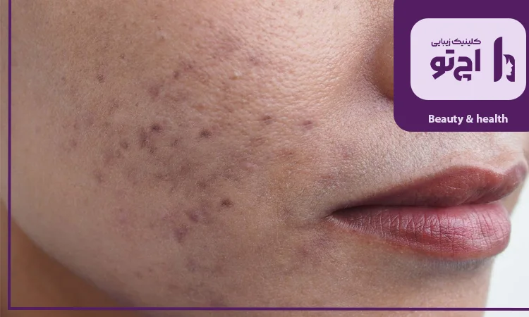 آفتاب و محیط؛ علت تیره شدن چهره