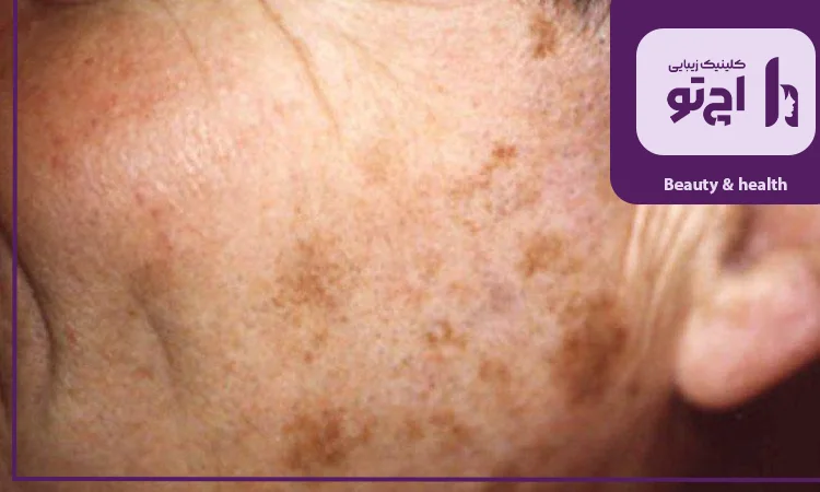 بررسی درمان های کلینیکی و جوانسازی صورت