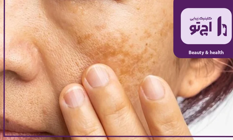 بررسی ریشه های درونی تیرگی