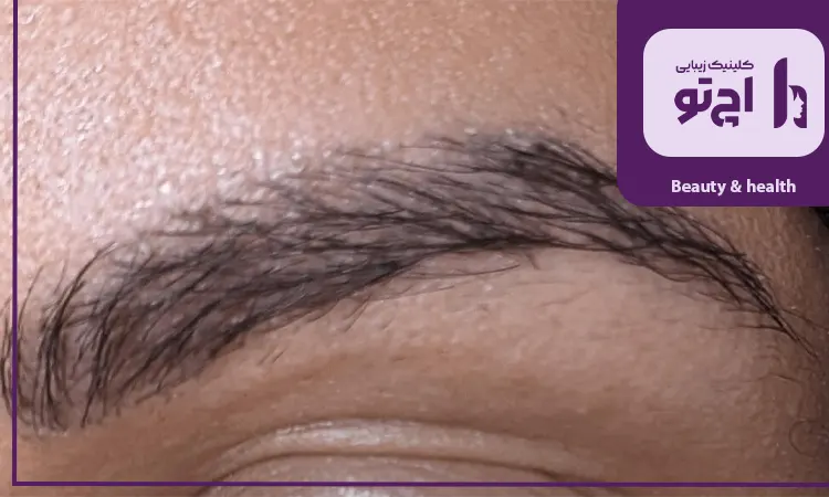 کاشت ابرو ابروهای کم پشت ارثی